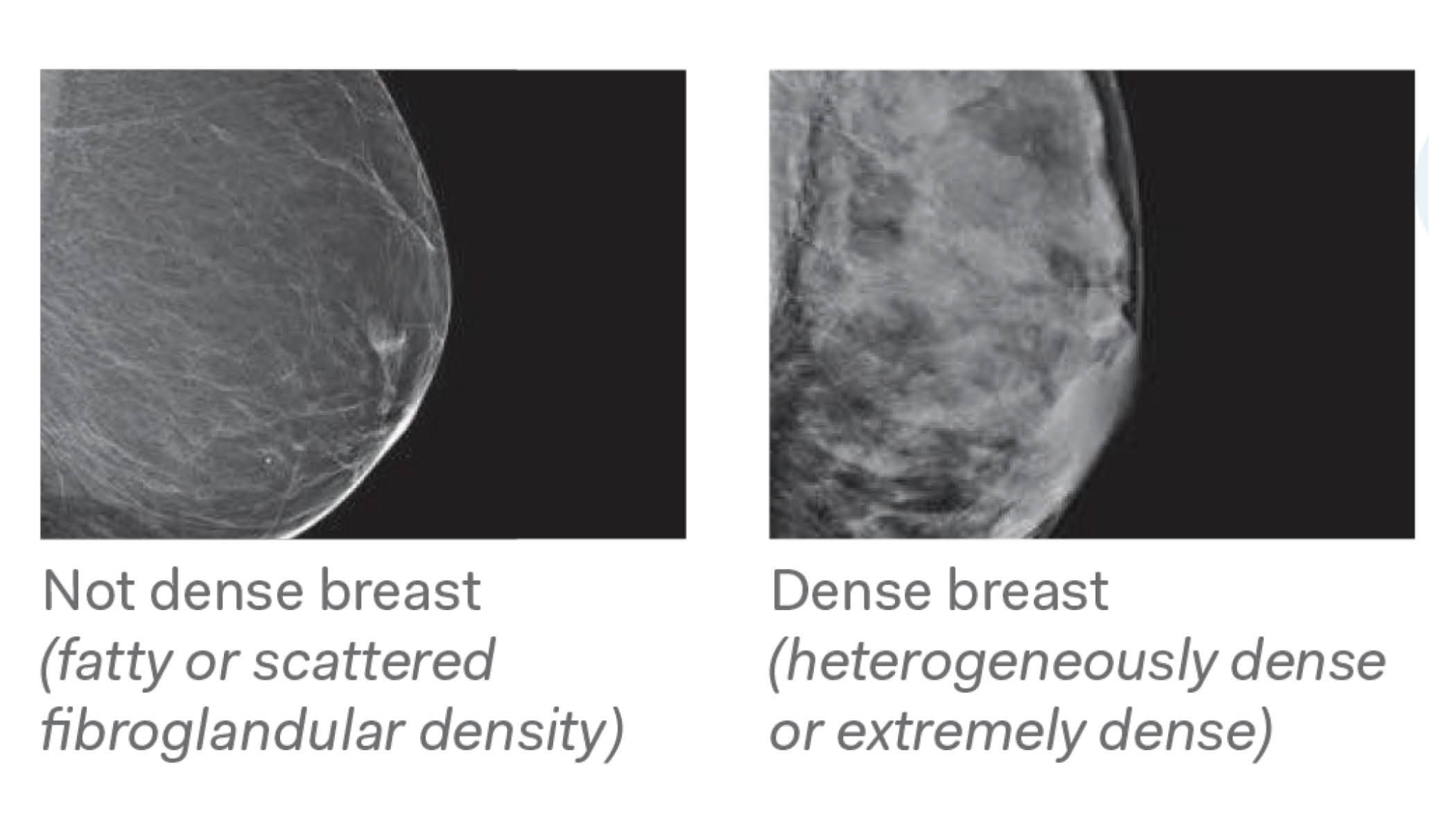 Breast Density 1 - TRA Medical Imaging