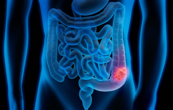 Colorectal Cancer Preventable and Treatable, Yet Deadly