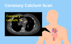 CT Cardiac Calcium Score: Michele's Story