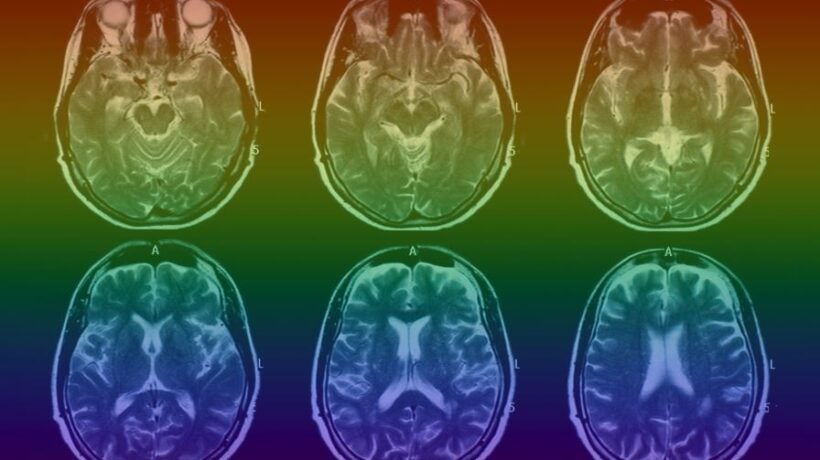 Rainbow gradient MRI Brain