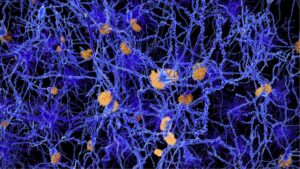 Beta Amyloid Plaque